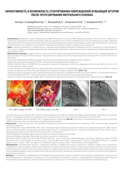 Эффективность и возможность стентирования поврежденной огибающей артерии после протезирования митрального клапана